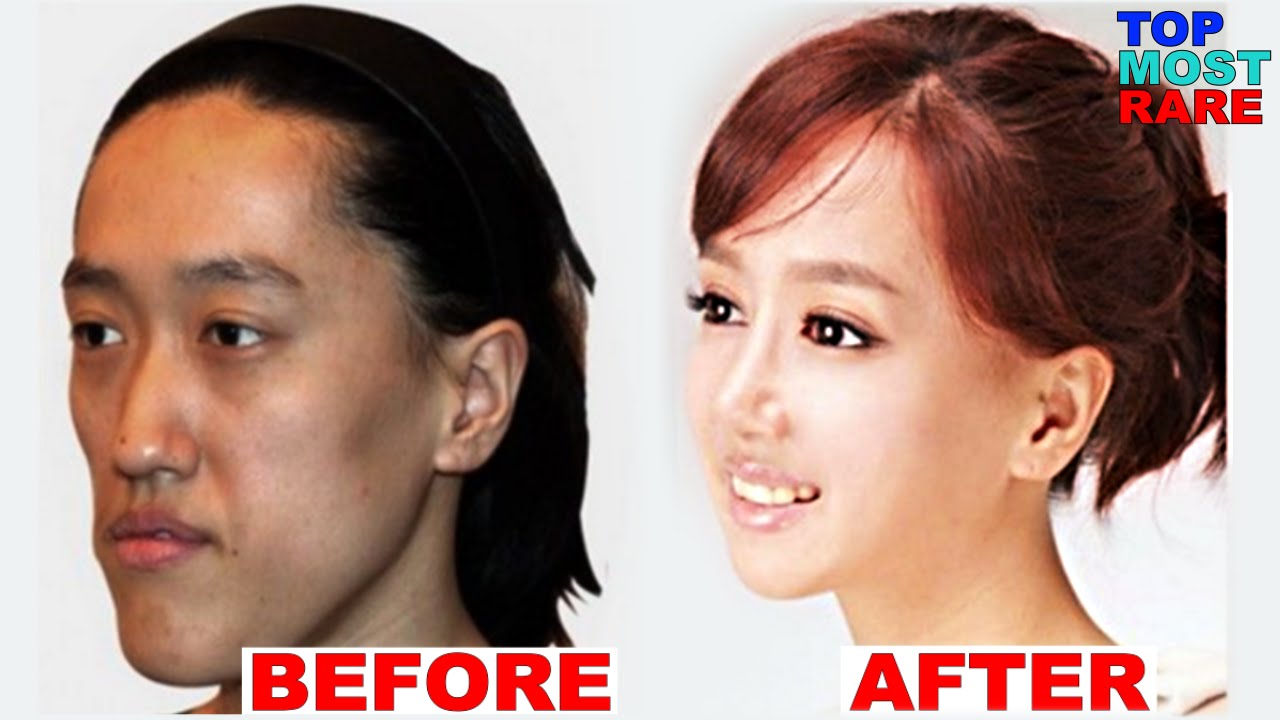 50 Korean Plastic Surgery Before and After Photos